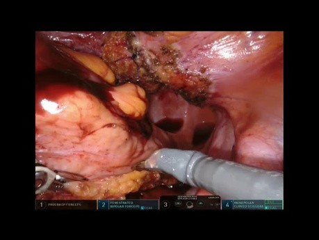 Résection Robotisée du Sigmoïde T4 avec Résection de la Vessie et de l'Intestin Grêle en Bloc