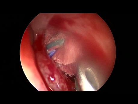 Chirurgie Endoscopique Complète des Sinus pour la Rhinosinusite Chronique Sphénoïde
