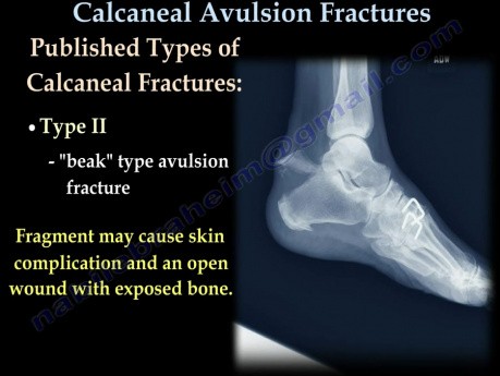 Lésions du Calcanéus - Fractures d'avulsion