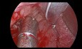 Hémostase du saignement post-amygdalectomie