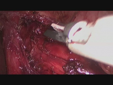 Le traitement laparoscopique de l'achalasie - cardiomyotomie de Heller avec fundoplicature de Dor