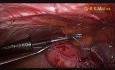 Hystérectomie laparoscopique totale avec salpingo-ovariectomie bilatérale