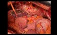 Transversectomie en Bloc avec Résection Gastrique Segmentaire, Hépatectomie Atypique 2-3 et Résection Partielle du Diaphragme et du Péricarde pour un Adénocarcinome du Côlon Transverse Localement Avancé