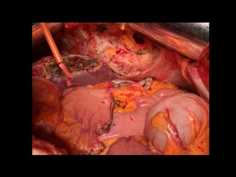 Transversectomie en Bloc avec Résection Gastrique Segmentaire, Hépatectomie Atypique 2-3 et Résection Partielle du Diaphragme et du Péricarde pour un Adénocarcinome du Côlon Transverse Localement Avancé