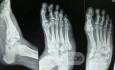 L'ostéoarthropathie diabétique (OD) - le pied de Charcot.
