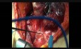 Surveillance peropératoire du nerf laryngé récurrent pendant la thyroïdectomie à l'aide de NIM-Response 3.0