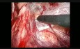 Traitement de la hernie inguinale par coelioscopie. Étape 4: dissection à droite