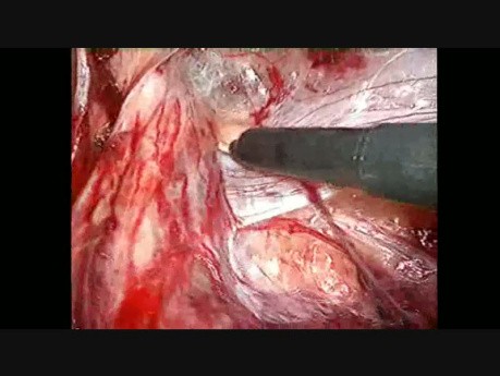 Traitement de la hernie inguinale par coelioscopie. Étape 4: dissection à droite