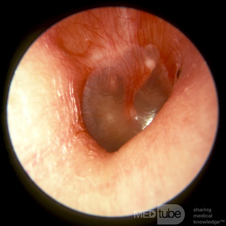 Réflexe rouge de la membrane tympanique normale