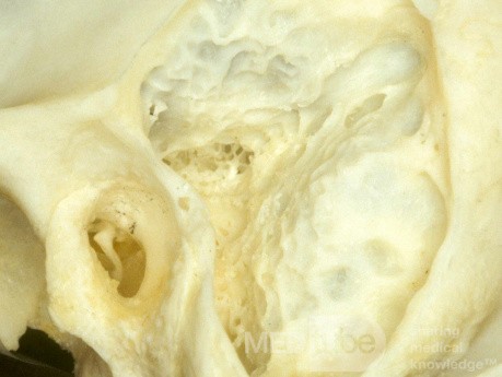 Cellules mastoïdiennes - cavités aériennes de l'os temporal
