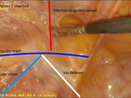 Nouveau concept anatomique pour la réparation laparoscopique des hernies inguinales