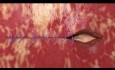 Démonstration des Sutures à Barbes Unidirectionnelles Quill® pour la Fermeture du Dôme Vaginal