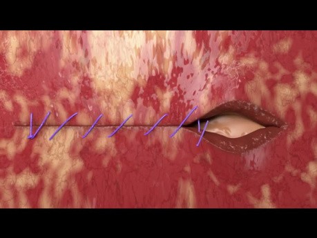 Démonstration des Sutures à Barbes Unidirectionnelles Quill® pour la Fermeture du Dôme Vaginal