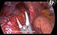 Myotomie de Heller par laparoscopie en cas d'achalasie concomitante à une grosse hernie hiatale