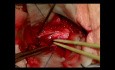 Hémangioblastome du rachis cervical C2