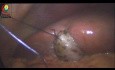 Une Vésicule Biliaire difficile peur être rétractée avec des sutures