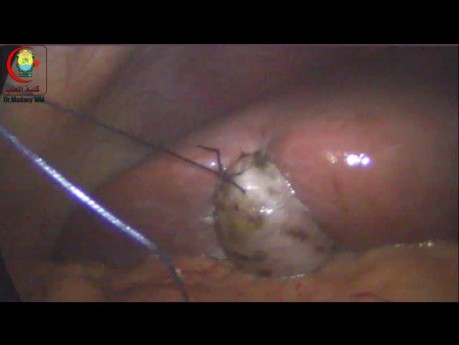 Une Vésicule Biliaire difficile peur être rétractée avec des sutures