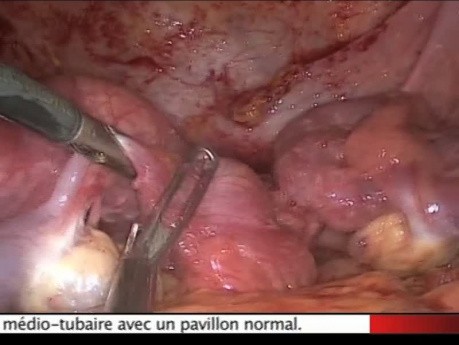 Tuberculose Génitale