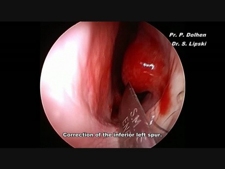 Septoplastie endoscopique: petit cornet inférieur