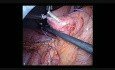 Jéjunostomie au Cours du Traitement du Cancer de l'Ovaire