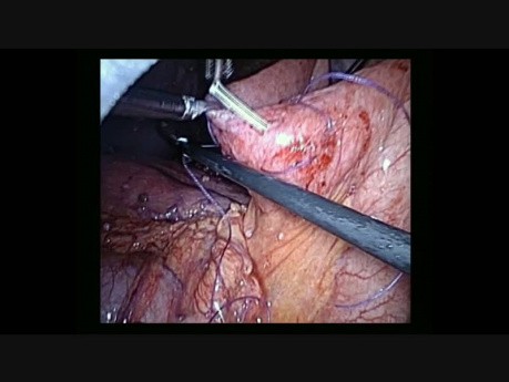 Jéjunostomie au Cours du Traitement du Cancer de l'Ovaire