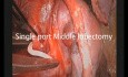 Lobectomie Vidéo-Thoracoscopique Uniportale à l'aide des Clips Vasculaires