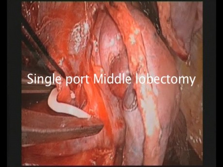 Lobectomie Vidéo-Thoracoscopique Uniportale à l'aide des Clips Vasculaires