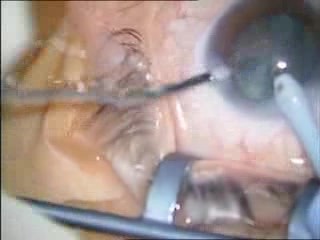 Chirurgie de la cataracte - phacoémulsification