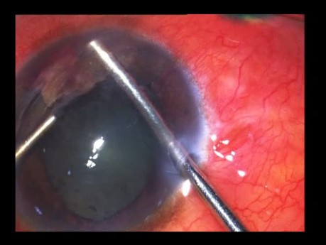 Corps étranger intraoculaire (CEIO) du segment antérieur