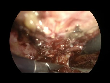 Fistule entre la Prostate et la Symphyse Pubienne: Correction Laparoscopique Extrapéritonéale