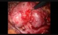 Pyélolithotomie par laparoscopie dans le rein en fer à cheval