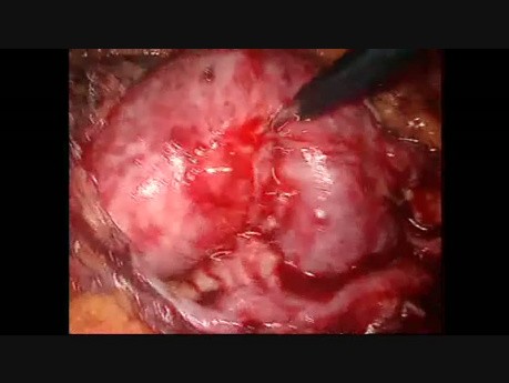Pyélolithotomie par laparoscopie dans le rein en fer à cheval