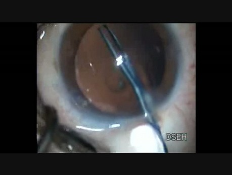 Incisions antérieures et postérieures dans la cataracte polaire postérieure.