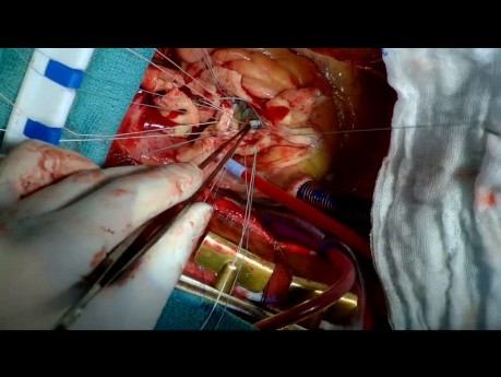 Remplacement de la racine aortique avec un conduit à valve mécanique pour traiter l'anévrisme de la racine aortique