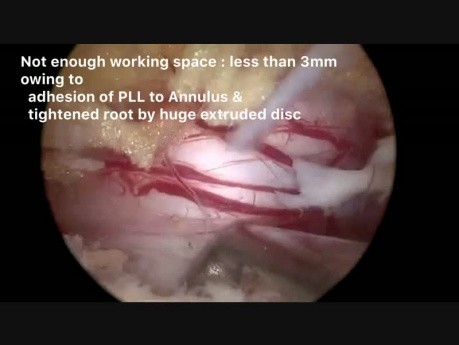 Discectomie endoscopique par une technique biportale