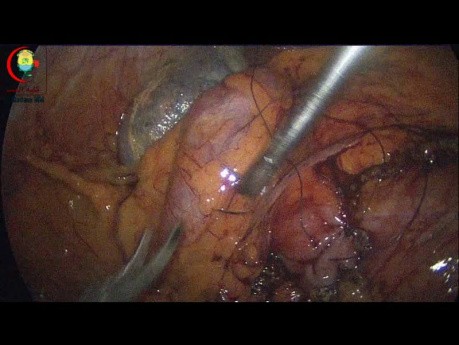 Les Lésions Thermiques de l'Intestin doivent être recouvertes de Sutures Séro-musculaires Transversales