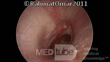 Perforation de la membrane tympanique - phase inactive.