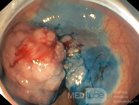 La dissection sous-muqueuse endoscopique de la tumeur rectale 1