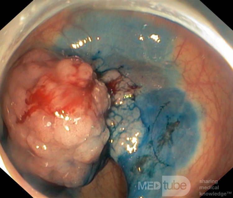 La dissection sous-muqueuse endoscopique de la tumeur rectale 1