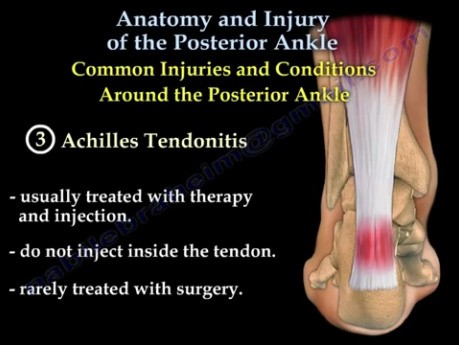 Cheville postérieure, anatomie et blessure