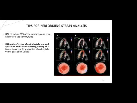 Amylose Cardiaque du Point de Vue Echocardiographique