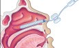 Cautérisation Nasale et Tamponnement Nasal Antéropostérieur 