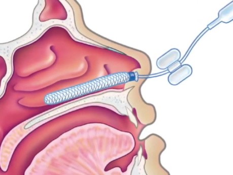 Cautérisation Nasale et Tamponnement Nasal Antéropostérieur 