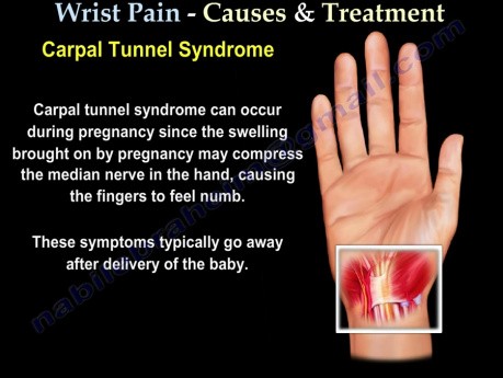 Causes et traitement de la douleur au poignet - Partie 1