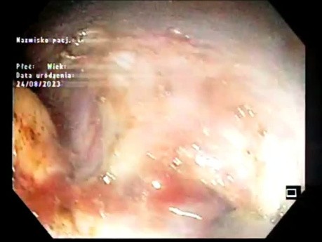 Dissection Sous-Muqueuse d'un Large LST-G de Type Mixte de 11 x 5 cm - Patient avec Syndrome de Fragilité
