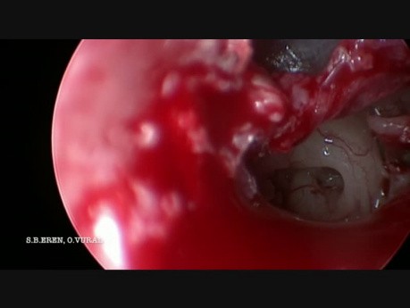 Stapédectomie par voie endoscopique