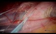 Résection Laparoscopique de Deux Tumeurs Gastriques