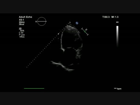 Cardiomyopathie dilatée (CMD) et thrombus de l'apex du cœur