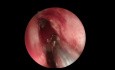 Chirurgie Endoscopique Complète du Sinus Gauche 3 - Vidéo Peu Editée