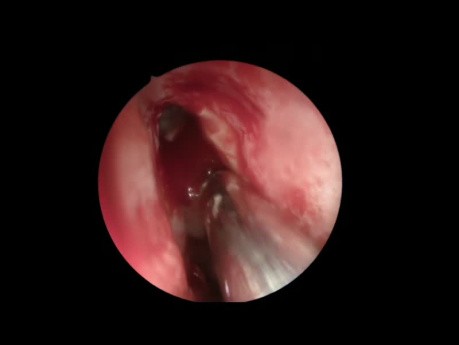 Chirurgie Endoscopique Complète du Sinus Gauche 3 - Vidéo Peu Editée